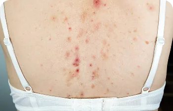 Back acne – close-up of the upper back