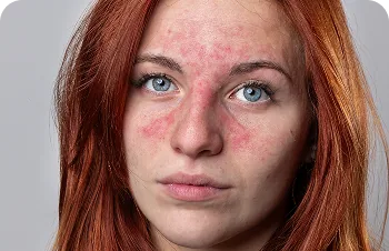 Adult acne – woman with red patches on her cheeks