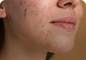 Close-up of a cheek with acne