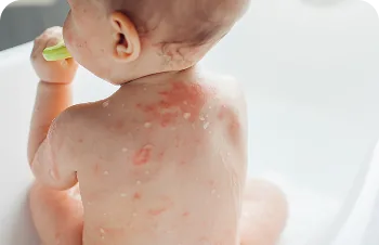 Atopic dermatitis in babies – baby with red patches on the back