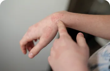 Atopic dermatitis in children – child's arm with red, irritated skin