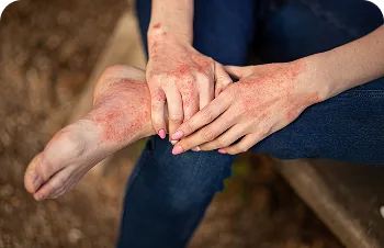 Atopic dermatitis in adults – hands and leg with red patches