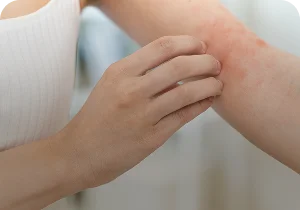 Hands scratching irritated skin on the forearm – atopic dermatitis