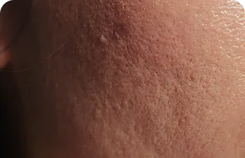 Atrophic scars – close-up of skin with depressed scars