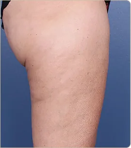 Non-surgical butt lift – buttocks and thigh in profile, after treatment (photo 4)