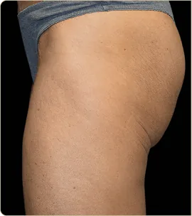 Non-surgical butt lift – buttocks in profile, before treatment (photo 3)