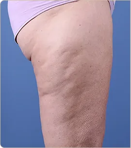 Non-surgical butt lift – buttocks and thigh in profile, before treatment (photo 4)