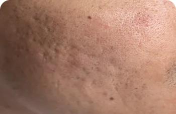 Acne scars – close-up of a cheek with scarring