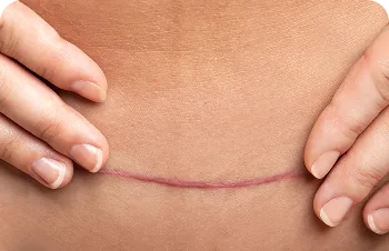 Wound and surgical scars – scar on the lower abdomen