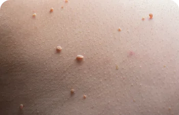 Warts and viral lesions – small growths on the skin