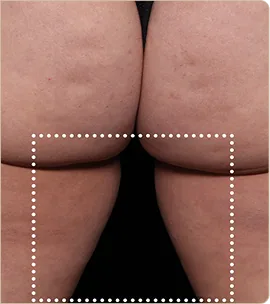 BTL Emsculpt Neo – buttocks and back of the thighs, after treatment (photo 1)