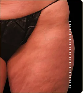 BTL Emsculpt Neo – hip and outer thigh, after treatment (photo 2)