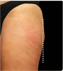 BTL Emsculpt Neo – outer thigh, after treatment (photo 3)