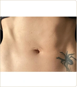 BTL Emsculpt Neo – abdomen, after treatment (photo 4)