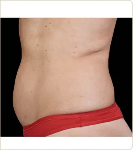 BTL Emsculpt Neo – abdomen in profile, after treatment (photo 5)