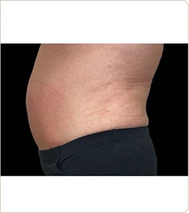 BTL Emsculpt Neo – abdomen in profile, after treatment (photo 6)
