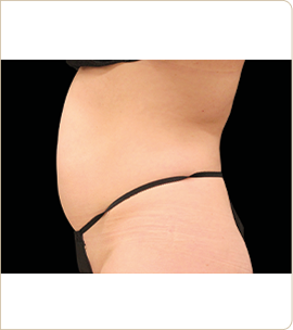BTL Emsculpt Neo – abdomen in profile, after treatment (photo 7)