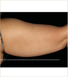 BTL Emsculpt Neo – back of the upper arm, after treatment (photo 8)