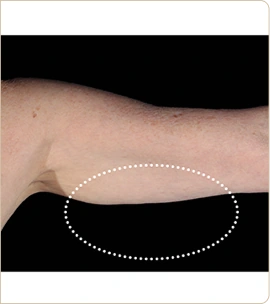 BTL Emsculpt Neo – back of the upper arm, after treatment (photo 9)