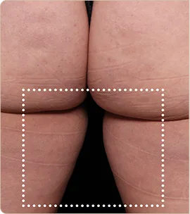 BTL Emsculpt Neo – buttocks and back of the thighs, before treatment (photo 1)