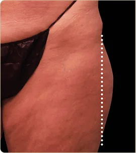 BTL Emsculpt Neo – hip and outer thigh, before treatment (photo 2)