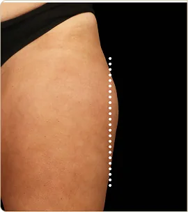 BTL Emsculpt Neo – outer thigh, before treatment (photo 3)