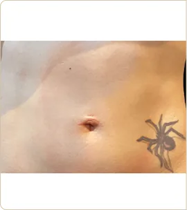 BTL Emsculpt Neo – abdomen, before treatment (photo 4)
