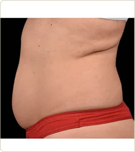 BTL Emsculpt Neo – abdomen in profile, before treatment (photo 5)
