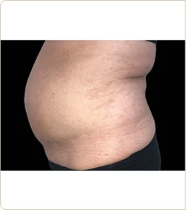 BTL Emsculpt Neo – abdomen in profile, before treatment (photo 6)