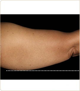 BTL Emsculpt Neo – back of the upper arm, before treatment (photo 8)