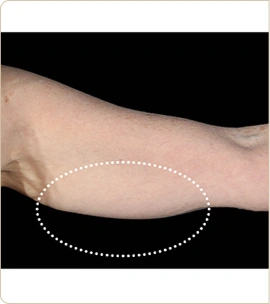 BTL Emsculpt Neo – back of the upper arm, before treatment (photo 9)