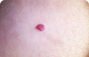 Red moles and angiomas – small red spot on the skin