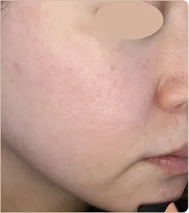 Dermapen medical microneedling – cheek, after treatment (photo 1)