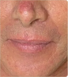 Dermapen medical microneedling – nose and mouth area, after treatment (photo 2)