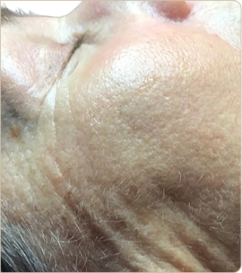 Dermapen medical microneedling – cheek and temple with wrinkles, after treatment (photo 3)