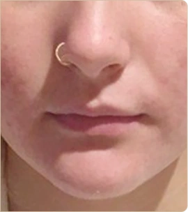 Dermapen medical microneedling – chin and mouth area, after treatment (photo 4)