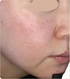 Dermapen medical microneedling – cheek, before treatment (photo 1)