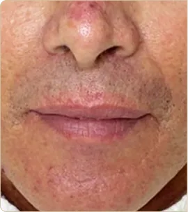 Dermapen medical microneedling – nose and mouth area, before treatment (photo 2)