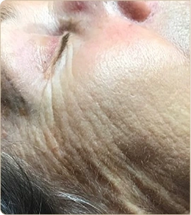 Dermapen medical microneedling – cheek and temple with wrinkles, before treatment (photo 3)