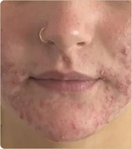 Dermapen medical microneedling – chin and mouth area, before treatment (photo 4)