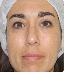 DermaV by Cynosure Lutronic – face with freckles, after treatment (photo 1)