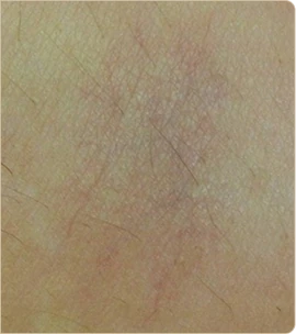 DermaV by Cynosure Lutronic – skin with visible capillaries, after treatment (photo 2)