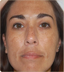 DermaV by Cynosure Lutronic – face with freckles, before treatment (photo 1)