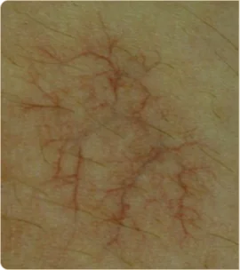 DermaV by Cynosure Lutronic – skin with visible capillaries, before treatment (photo 2)