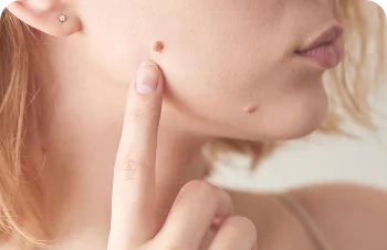 Benign skin lesions – woman pointing to a small mole on her chin