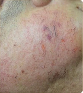 eCO2 3D by Cynosure Lutronic – cheek with visible capillaries, after treatment (photo 1)