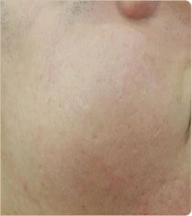 eCO2 3D by Cynosure Lutronic – cheek, after treatment (photo 2)