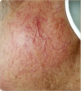 eCO2 3D by Cynosure Lutronic – cheek with visible capillaries, before treatment (photo 1)