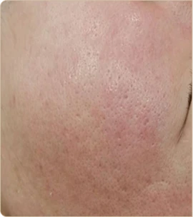 eCO2 3D by Cynosure Lutronic – cheek, before treatment (photo 2)
