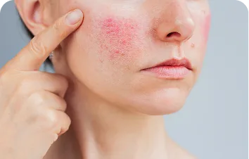Erythematotelangiectatic rosacea – woman pointing to a reddened cheek